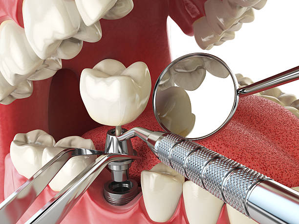 Best Urgent Care for Lost Fillings or Crowns in Flora, IL